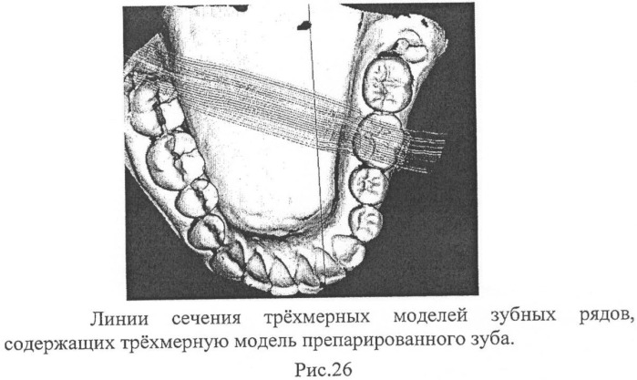 Способ контроля препарирования окклюзионной поверхности зубов при ортопедическом лечении несъемными протезами (патент 2396921)