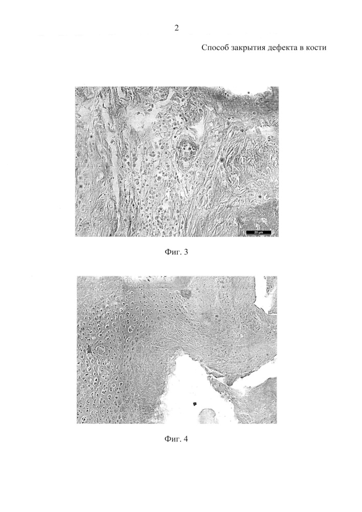 Способ закрытия дефекта в кости (патент 2644828)