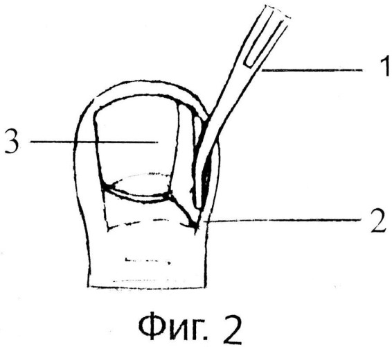 Способ лечения вросшего ногтя с использованием аппарата "сургитрон" (патент 2537782)
