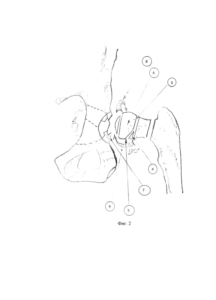 Способ эндопротезирования тазобедренного сустава при высокоэнергетическом двухколонном переломе вертлужной впадины при центральном вывихе бедра (патент 2644935)
