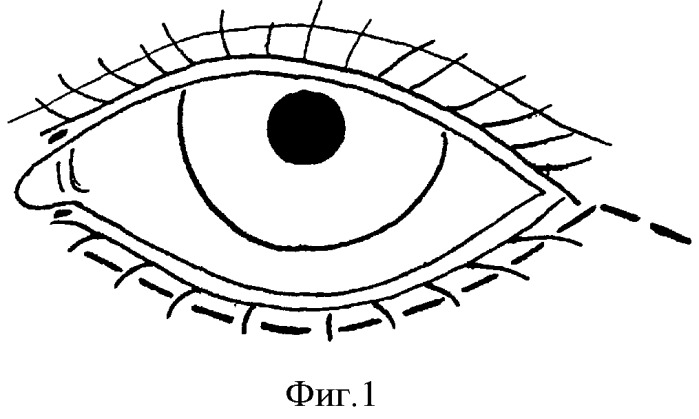 Способ устранения сенильного выворота нижнего века (патент 2380067)