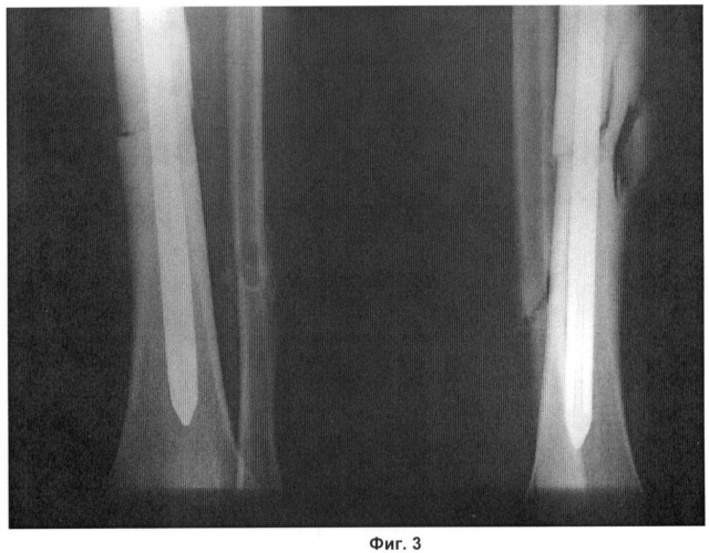 Способ лечения больных с переломами трубчатых костей (патент 2444320)