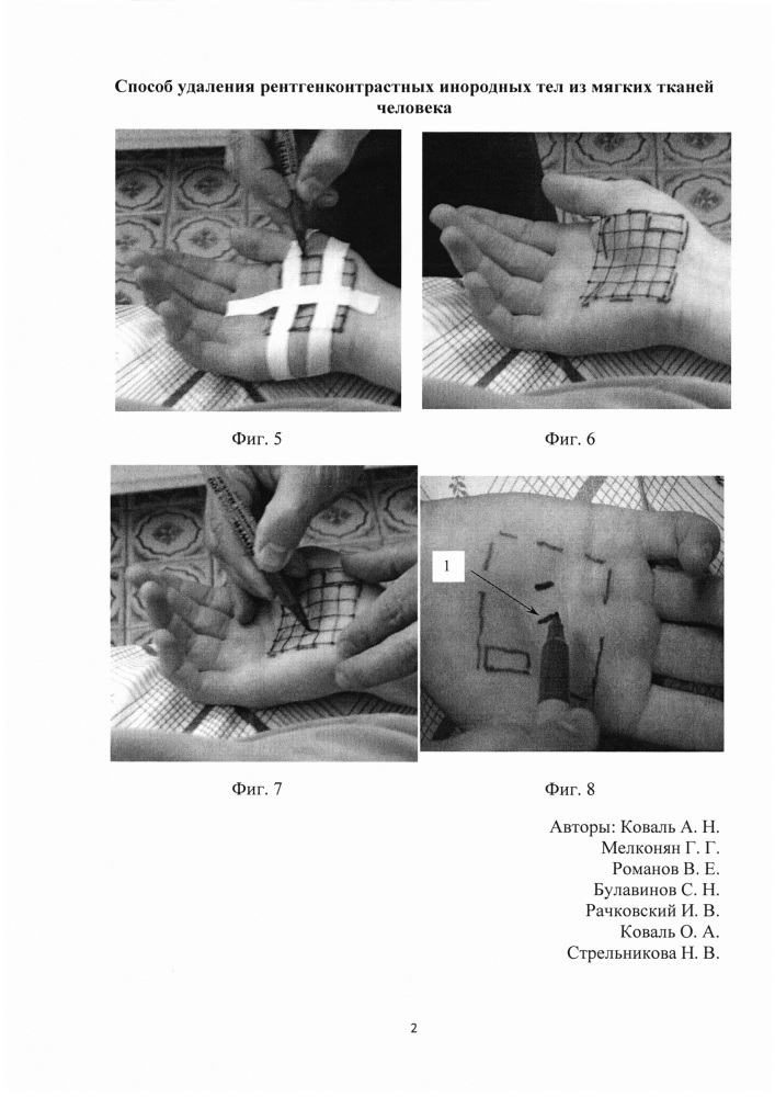 Способ удаления рентгенконтрастных инородных тел из мягких тканей человека (патент 2632517)