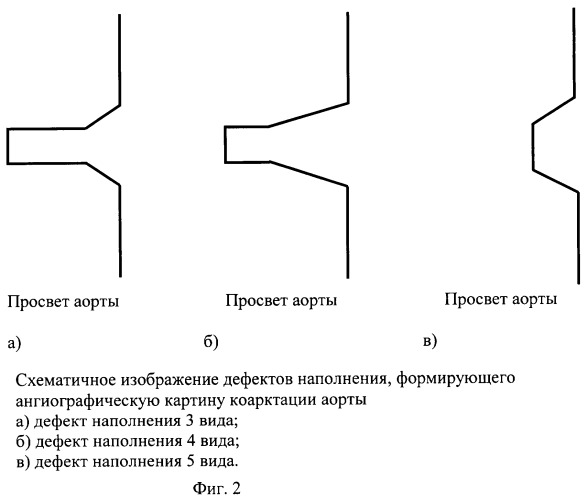 Способ диагностики изолированной коарктации аорты и способ выбора тактики ее лечения (патент 2244510)