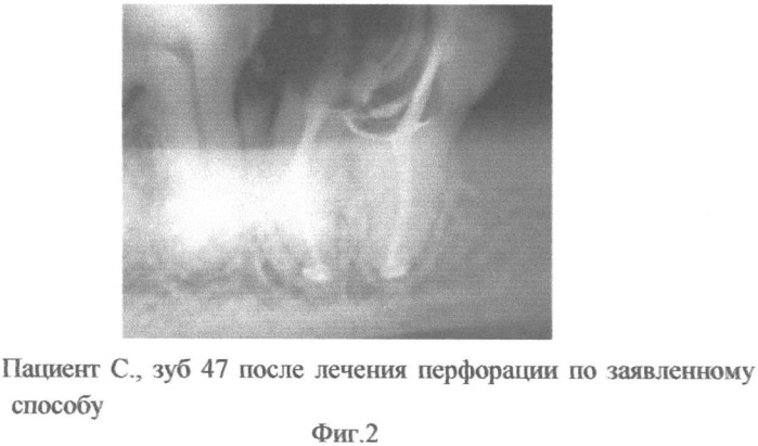 Способ лечения перфорации дна полости зуба (патент 2345732)