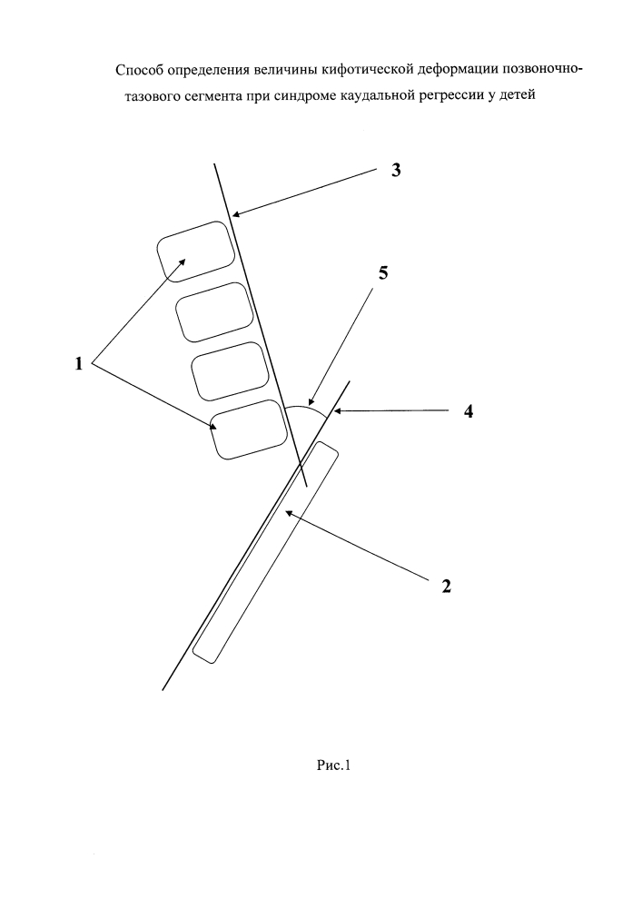 Способ определения величины кифотической деформации позвоночно-тазового сегмента при синдроме каудальной регрессии у детей (патент 2604041)