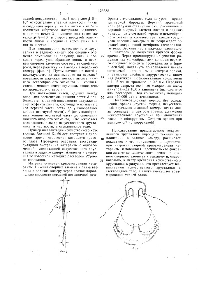 Искусственный хрусталик глаза (патент 1123685)