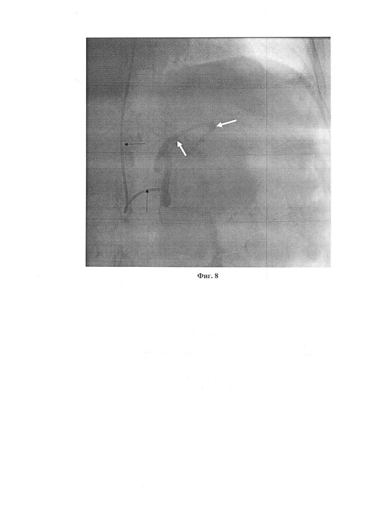 Способ рентгенэндоваскулярной эмболизации висцеральных ветвей через артерии верхних конечностей при помощи катетера headhunter при различных патологиях желудочно-кишечного тракта (патент 2652743)