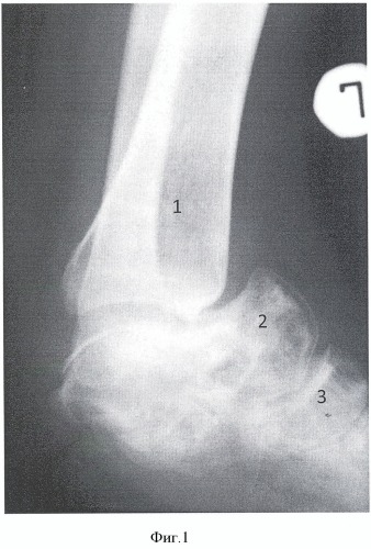 Способ реконструкции заднего отдела стопы при утрате пяточной кости (патент 2488360)