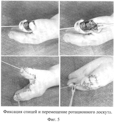 Способ оперативного лечения клинодактилии первого пальца кисти при акроцефалосиндактилии (патент 2546503)