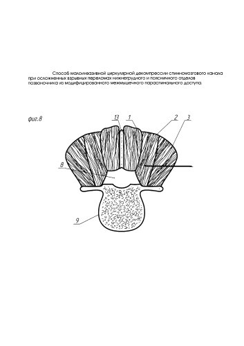 Способ малоинвазивной циркулярной декомпрессии спинномозгового канала при осложненных взрывных переломах нижнегрудного и поясничного отделов позвоночника из модифицированного межмышечного параспинального доступа (патент 2592779)