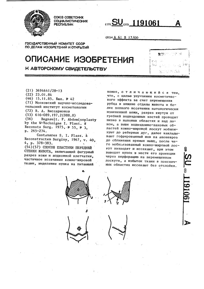 Способ пластики передней стенки живота (патент 1191061)