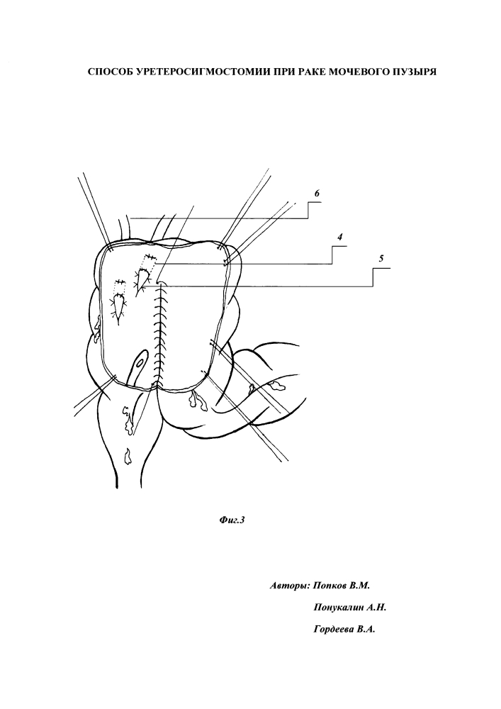 Способ уретеросигмостомии при раке мочевого пузыря (патент 2612189)