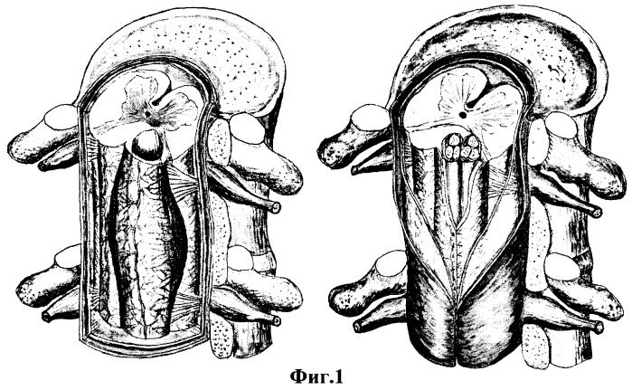 Способ пластики кист спинного мозга с помощью комбинированного биологического сосудисто-невро-фетонейрального трансплантата (патент 2272579)