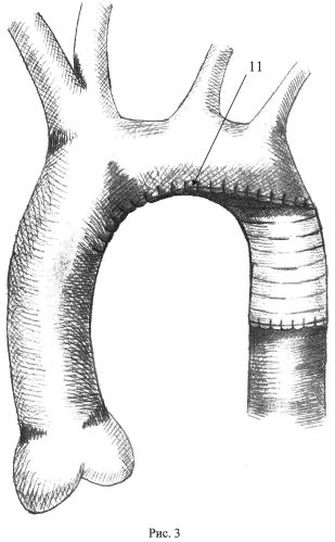 Способ коррекции коарктации и рекоарктации аорты в сочетании с гипоплазией дуги аорты (патент 2563436)