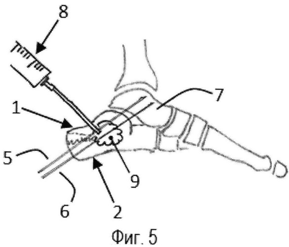 Способ оперативного лечения закрытых оскольчатых языкообразных переломов пяточной кости (патент 2520800)