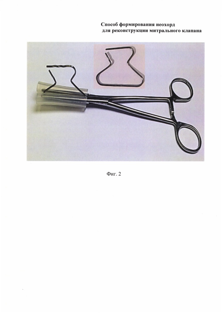 Способ формирования неохорд для реконструкции митрального клапана (патент 2629613)