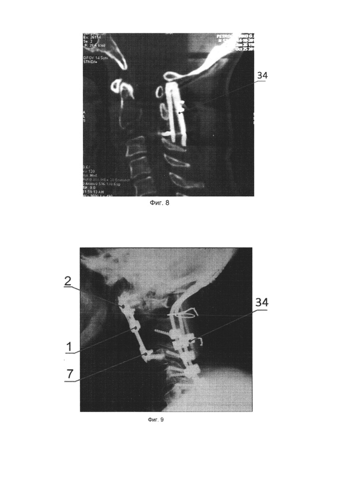 Устройство для передней стабилизации шейных позвонков атланто-субаксиального уровня (патент 2652741)
