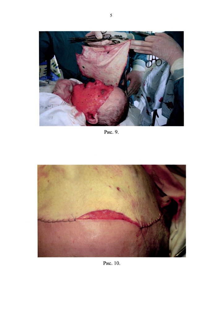 Способ хирургического лечения глубоких тотальных ожогов лица (патент 2632776)