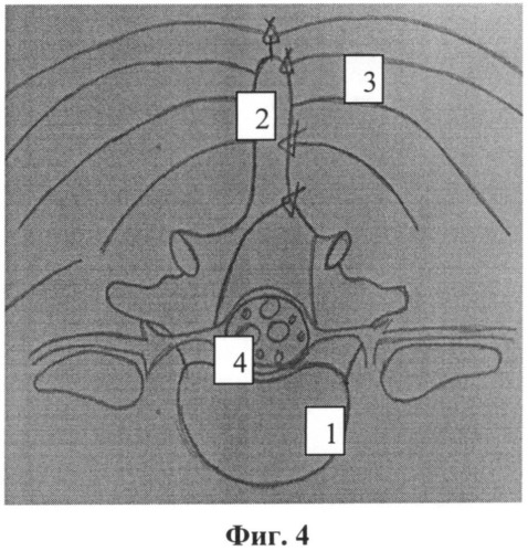 Способ доступа к позвоночному каналу при стенозирующем поражении пояснично-крестцового отдела позвоночника (патент 2508909)