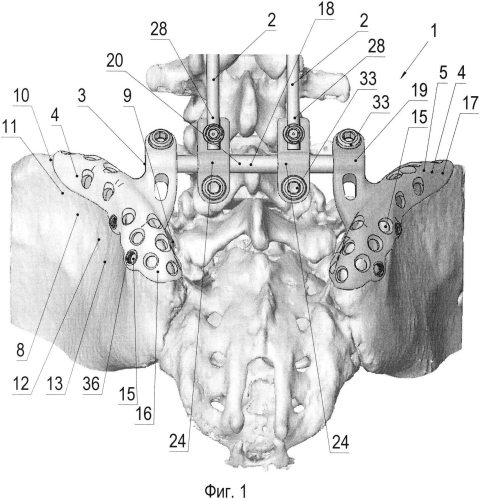 Устройство для фиксации, по меньшей мере, части грудного и/или поясничного отделов позвоночника человека к тазу (патент 2585733)