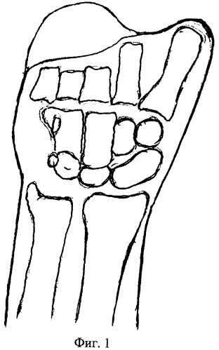 Способ реконструкции пястных костей (патент 2489980)