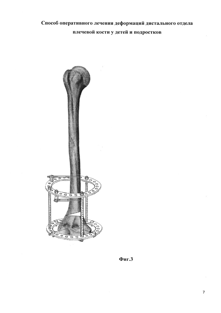 Способ оперативного лечения деформаций дистального отдела плечевой кости у детей и подростков (патент 2628650)
