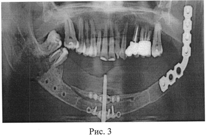 Способ дистракционного остеогенеза челюстей при дефиците костной ткани у пациентов после онкологических операций (патент 2563942)