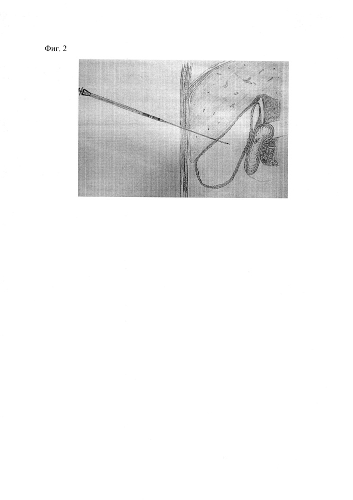 Способ наложения пункционного компрессионного холецистодуоденоанастомоза (патент 2648336)
