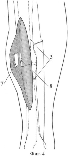 Способ хирургического лечения ложных суставов трубчатых костей конечностей (патент 2349279)
