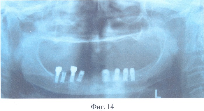 Зубной протез с опорой на внутрикостные имплантаты (патент 2326621)