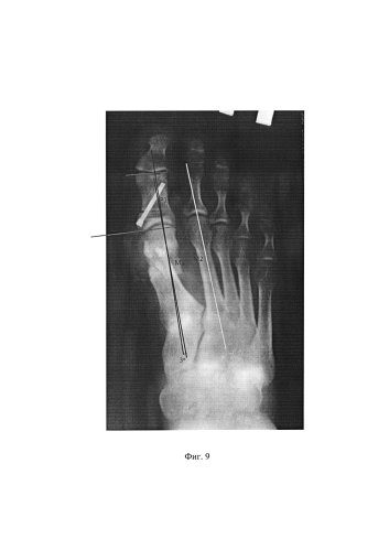 Способ оперативного лечения вальгусного отклонения первого пальца стопы (патент 2592604)
