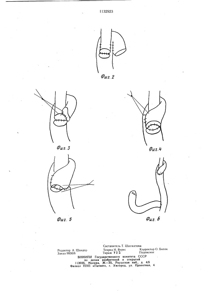 Способ наложения эзофагоеюноанастомоза (патент 1132923)