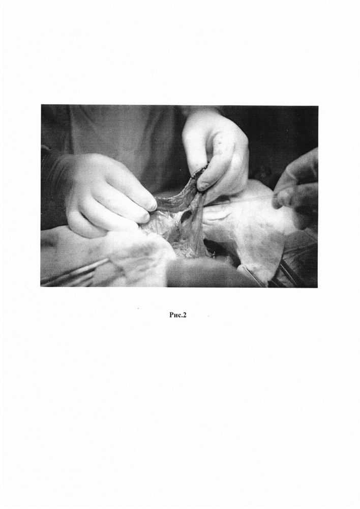 Способ органосохраняющей операции на селезёнке (патент 2649495)