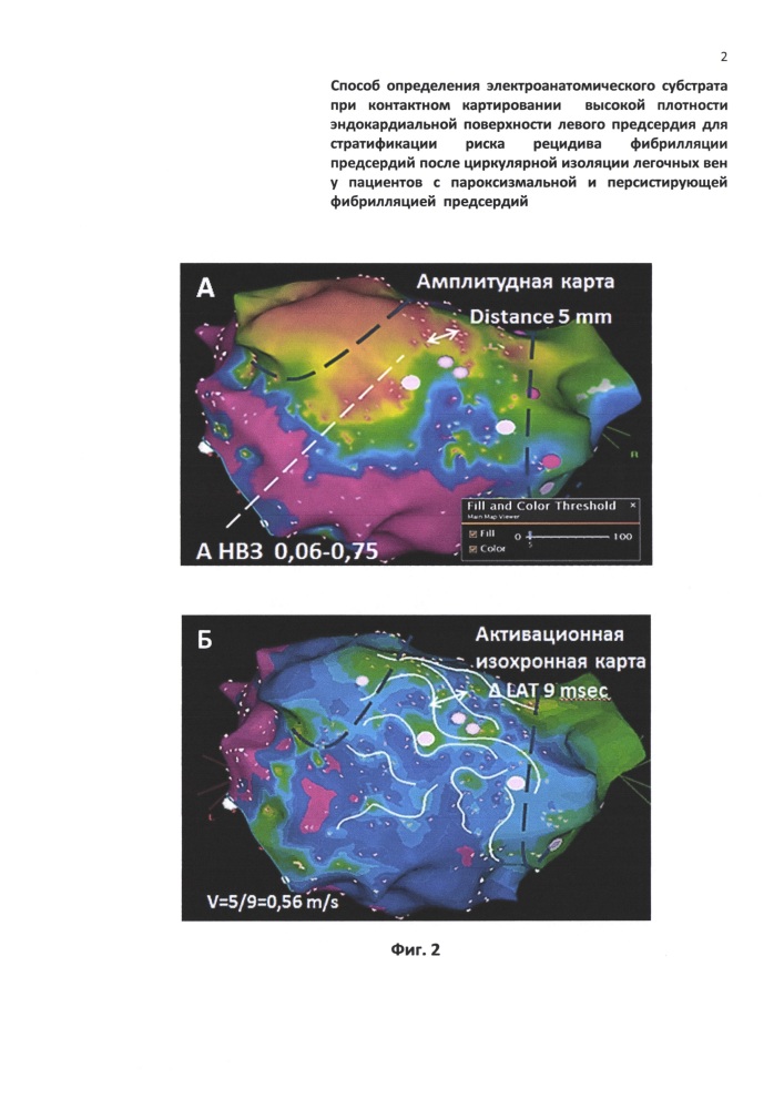 Способ определения электроанатомического субстрата при контактном картировании высокой плотности эндокардиальной поверхности левого предсердия для стратификации риска рецидива фибрилляции предсердий после циркулярной изоляции легочных вен у пациентов с пароксизмальной и персистирующей фибрилляцией предсердий (патент 2649506)