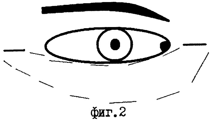 Способ устранения атонического выворота нижнего века (патент 2260413)