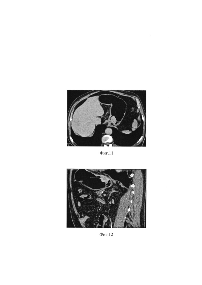 Способ компьютерно-томографического исследования желудка (патент 2621952)