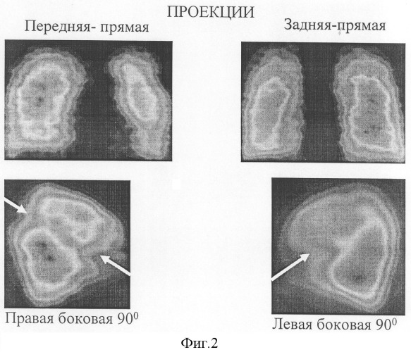 Способ диагностики тромболии мелких ветвей легочной артерии (патент 2303950)