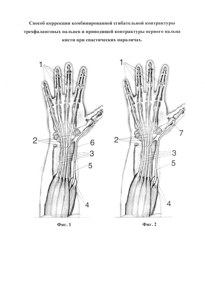 Способ коррекции комбинированной сгибательной контрактуры трехфаланговых пальцев и приводящей контрактуры первого пальца кисти при спастических параличах (патент 2627291)