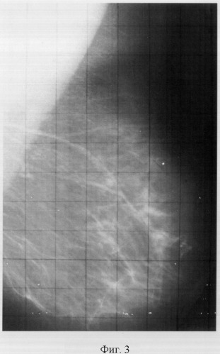 Способ оценки доли жировой ткани в молочной железе (патент 2325852)