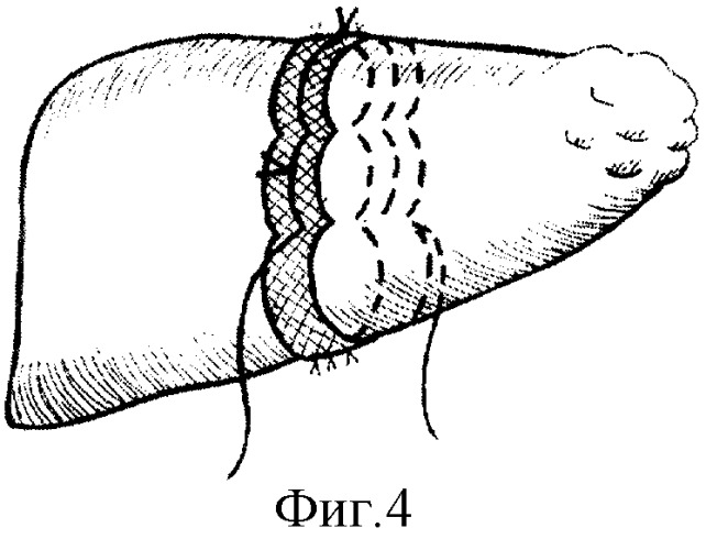 Способ резекции печени (патент 2278617)
