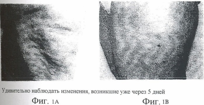 Способ фотодинамической терапии для лечения целлюлитов и косметического использования (патент 2444385)