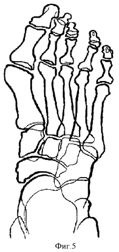 Способ оперативного лечения деформации переднего отдела стопы (патент 2428127)
