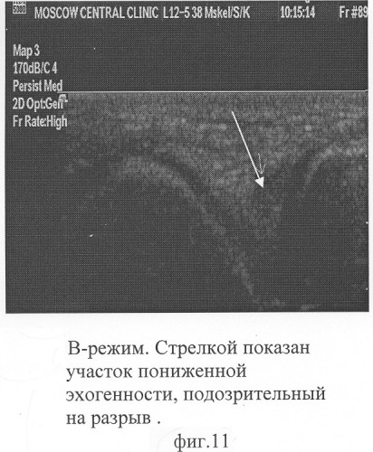 Способ комплексной ультразвуковой диагностики повреждения внутреннего мениска коленного сустава в области тела и переднего рога (патент 2305493)