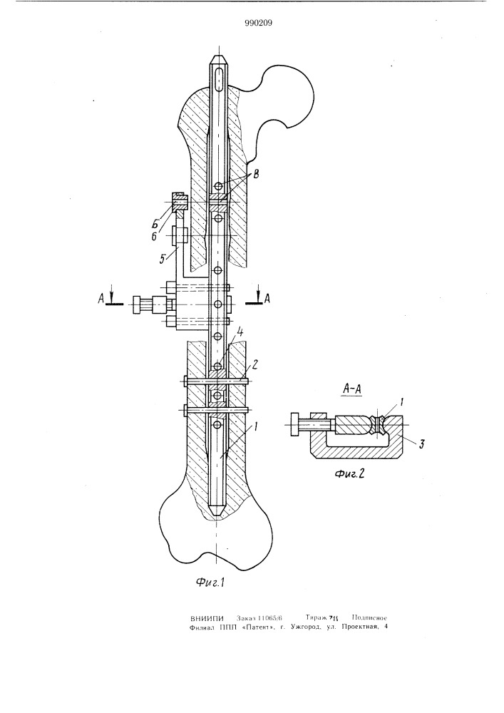 Устройство для фиксации фрагментов трубчатых костей (патент 990209)