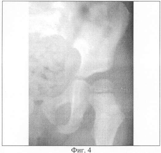 Способ лечения врожденной дисплазии вертлужной впадины (патент 2311884)