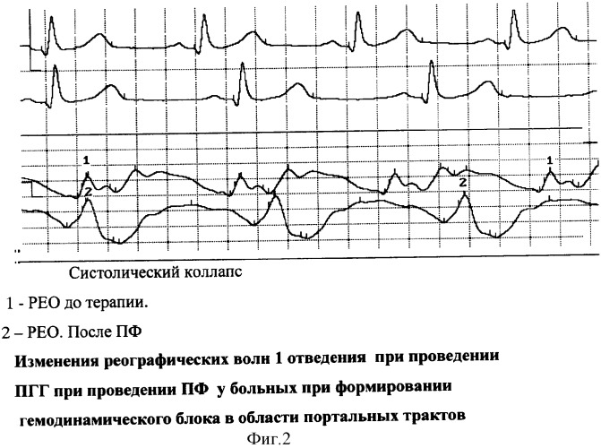 Способ прогнозирования риска развития осложнений, вызванных воздействием плазмафереза у больных хроническими заболеваниями печени (патент 2321337)