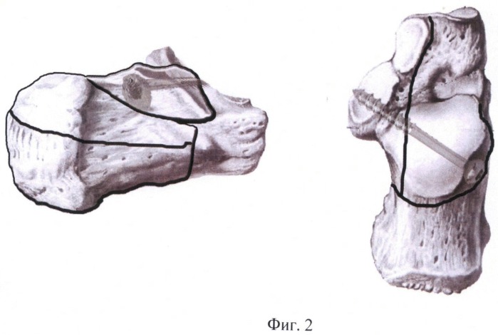 Способ лечения внутрисуставных импрессионных переломов пяточной кости (патент 2484785)