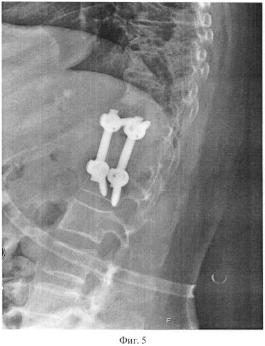 Способ остеосинтеза позвоночника при травмах и заболеваниях (патент 2559275)