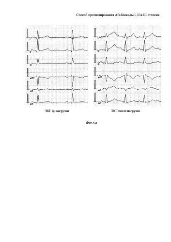 Способ прогнозирования ав-блокады i, ii и iii степени (патент 2591839)